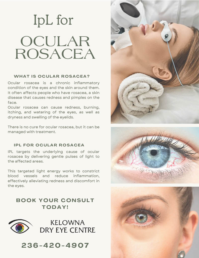 IpL for Rosacea